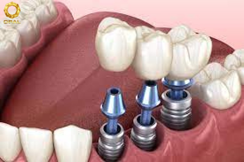 PHỤC HÌNH IMPLANT