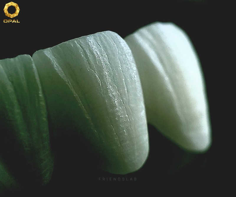 RĂNG SỨ KIM LOẠI